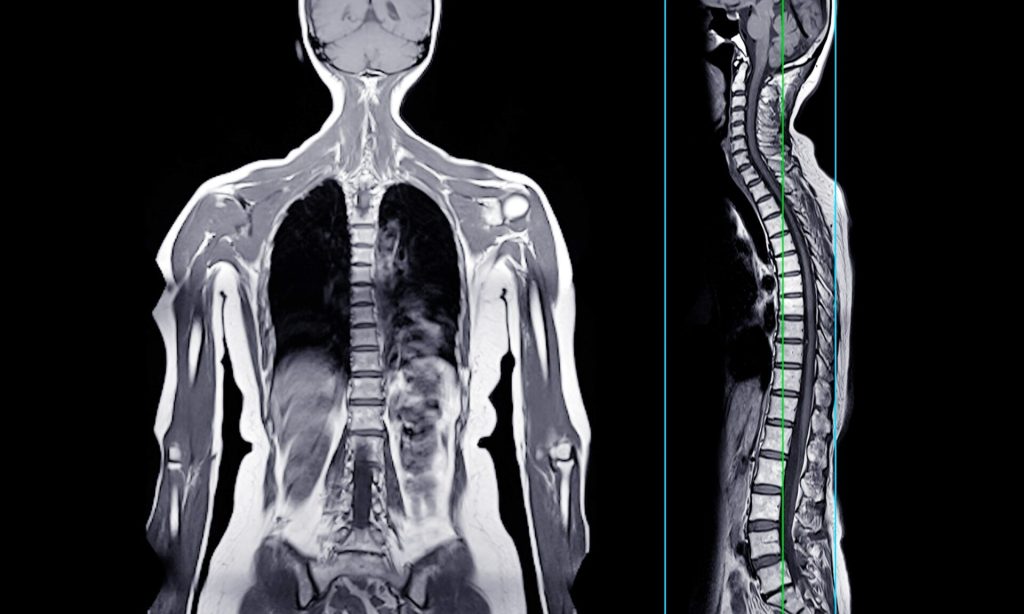 Mri,Whole,Body,Scans,Are,Beneficial,For,Early,Cancer,Detection,