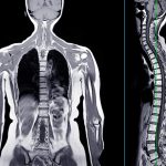 Mri,Whole,Body,Scans,Are,Beneficial,For,Early,Cancer,Detection,